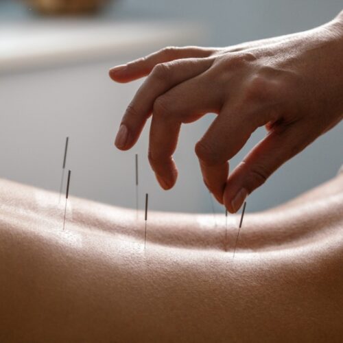 Acupuncture for Weight Loss