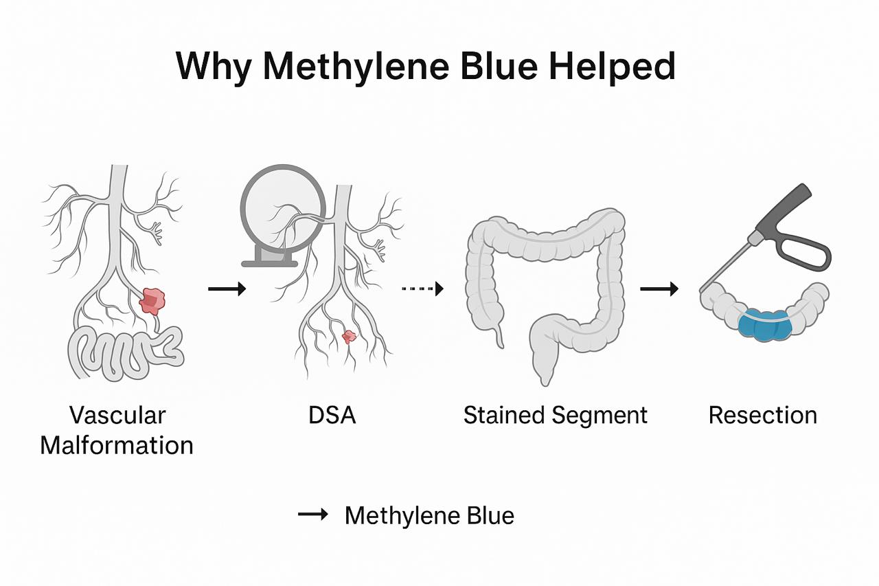 Methylene Blue Surgery: The Clever Trick Doctors Now Use to Find and Stop Hidden Gut Bleeds